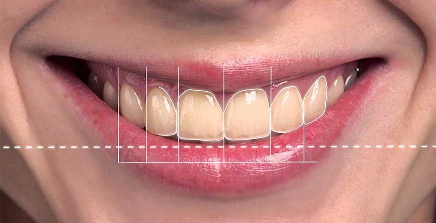 Un sorriso con le linee guida dello smile design