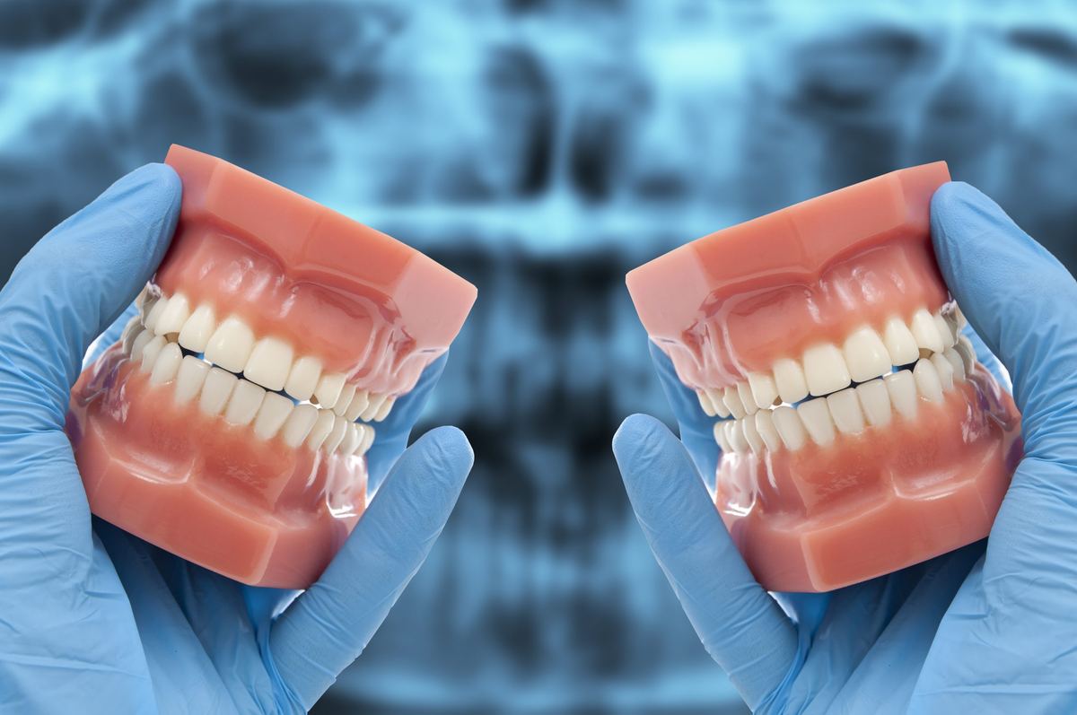 Due modelli di arcata dentale tenuti tra le mani, su una radiografia panoramica