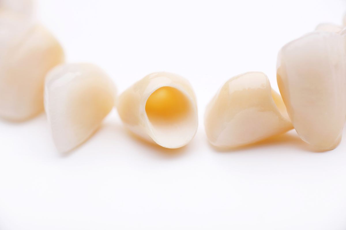 Corone dentali in ceramica